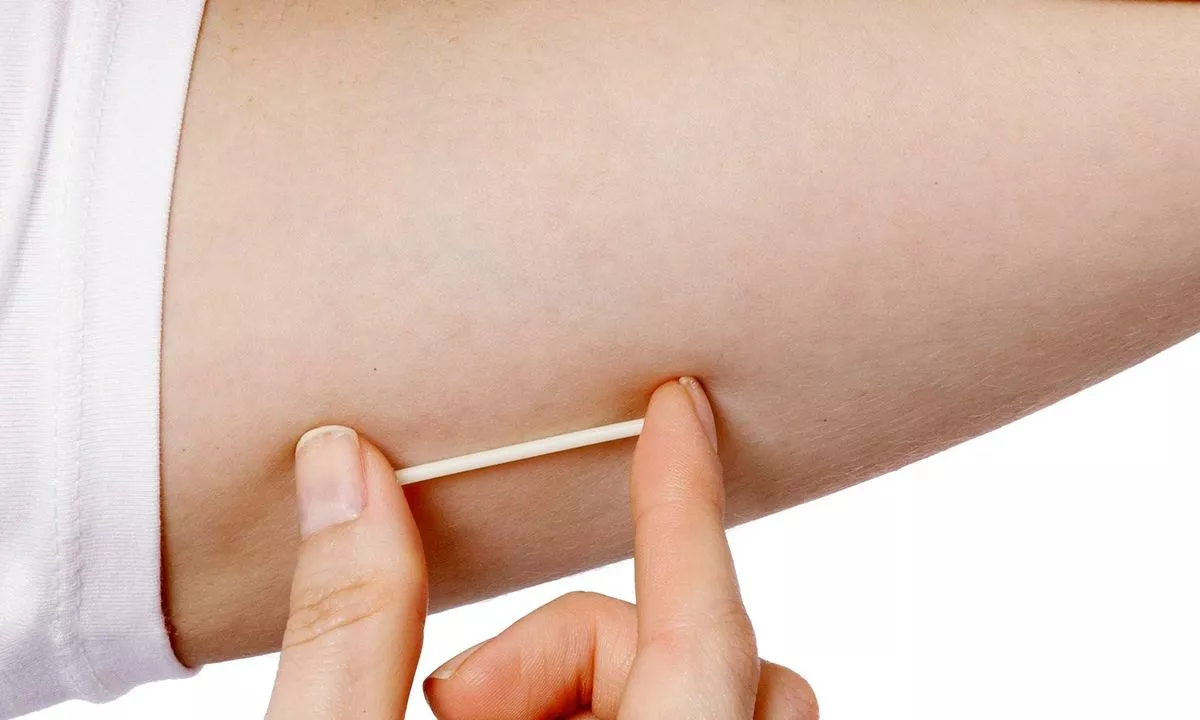 Implantes subdermicos